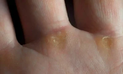 Dermatolojik Hastalıklar