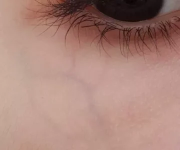 Göz Çevresinde Damar Belirginleşmesi