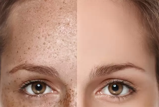 Leke Tedavisinde Q-switch Lazer